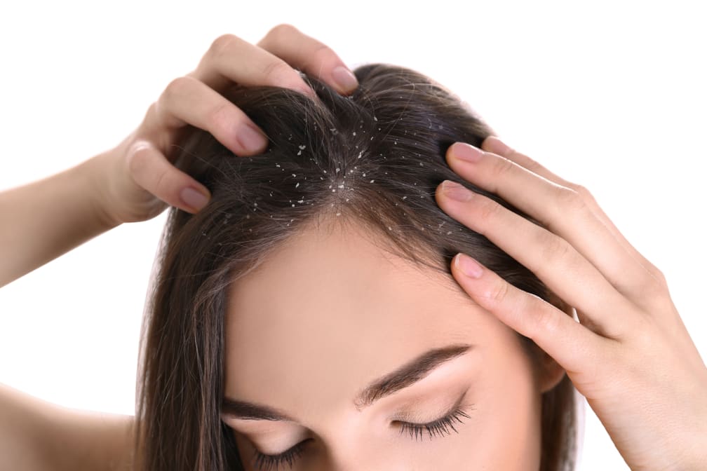 dandruff home remedies