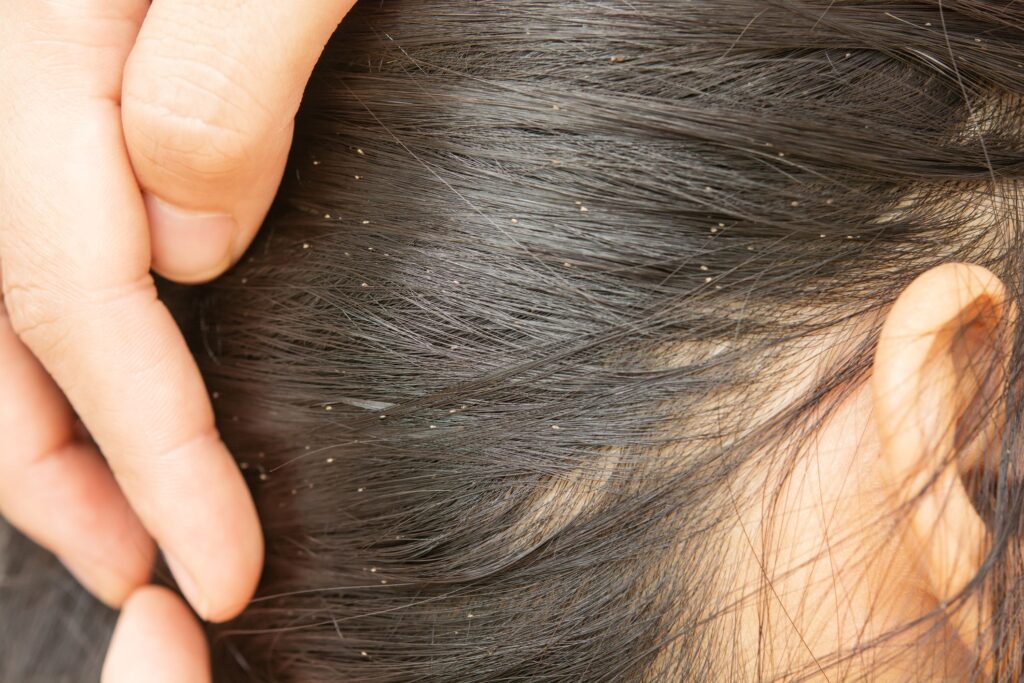 get rid of lice from hair