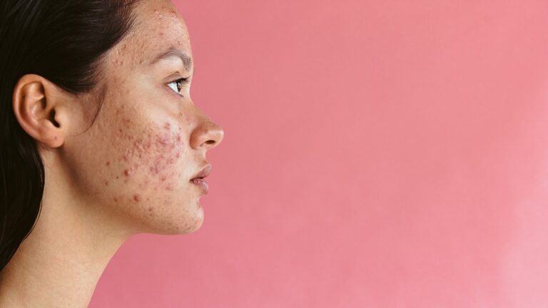 how to treat acne